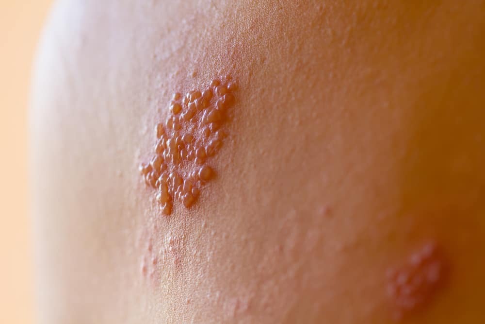 Gordelroos vaccinatie
